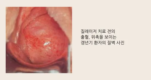 질레이저 치료 전 질벽 상태