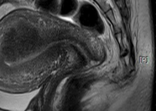 MRI