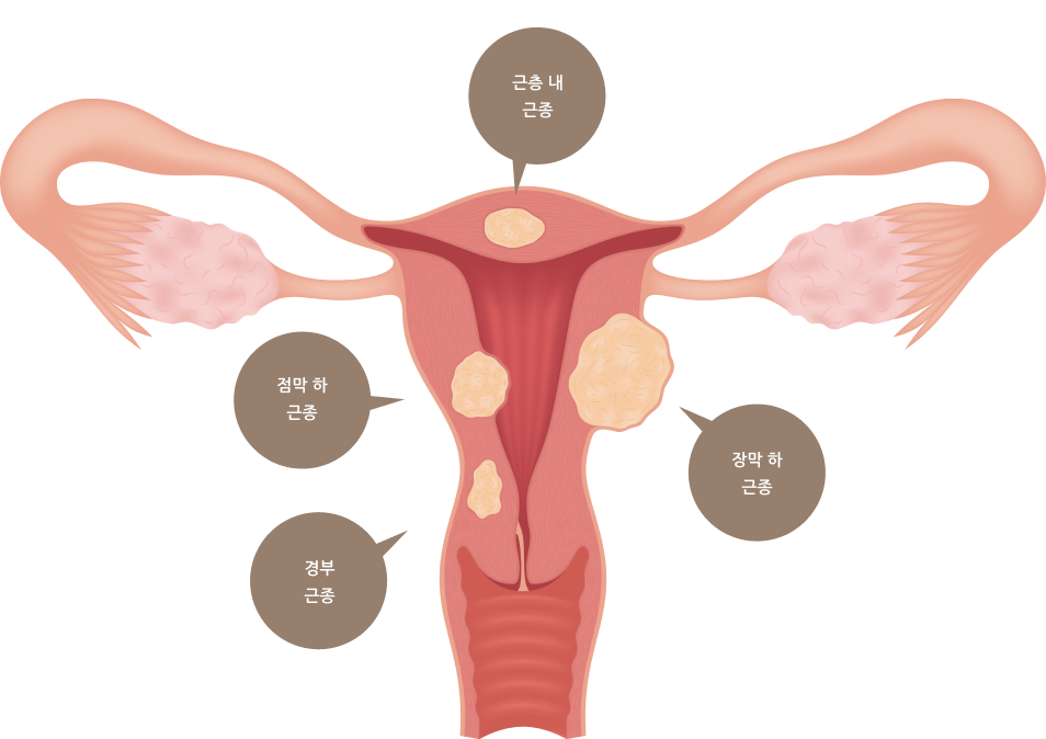 자궁근종 유형 도식